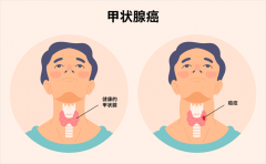 当甲状腺癌遇上靶向治疗，安罗替尼